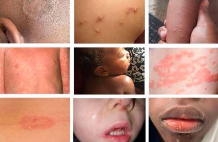 All You need to know about Rashes